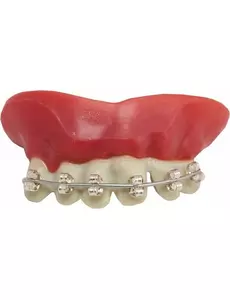 Denture braces