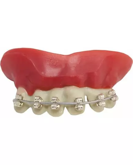 Denture braces